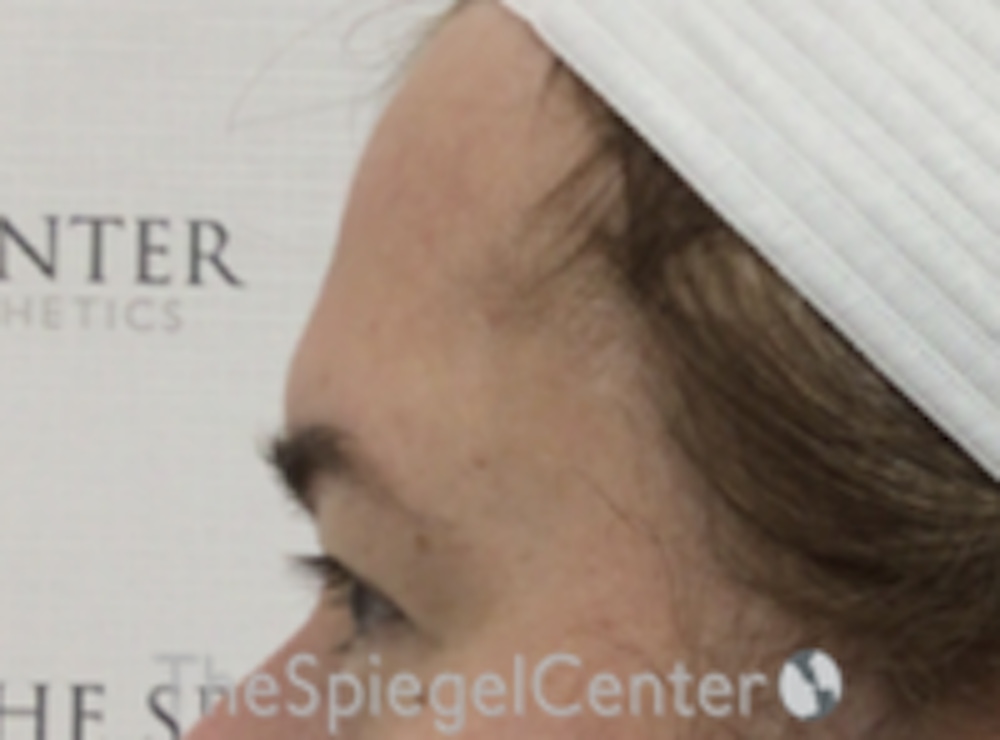 Forehead Contouring