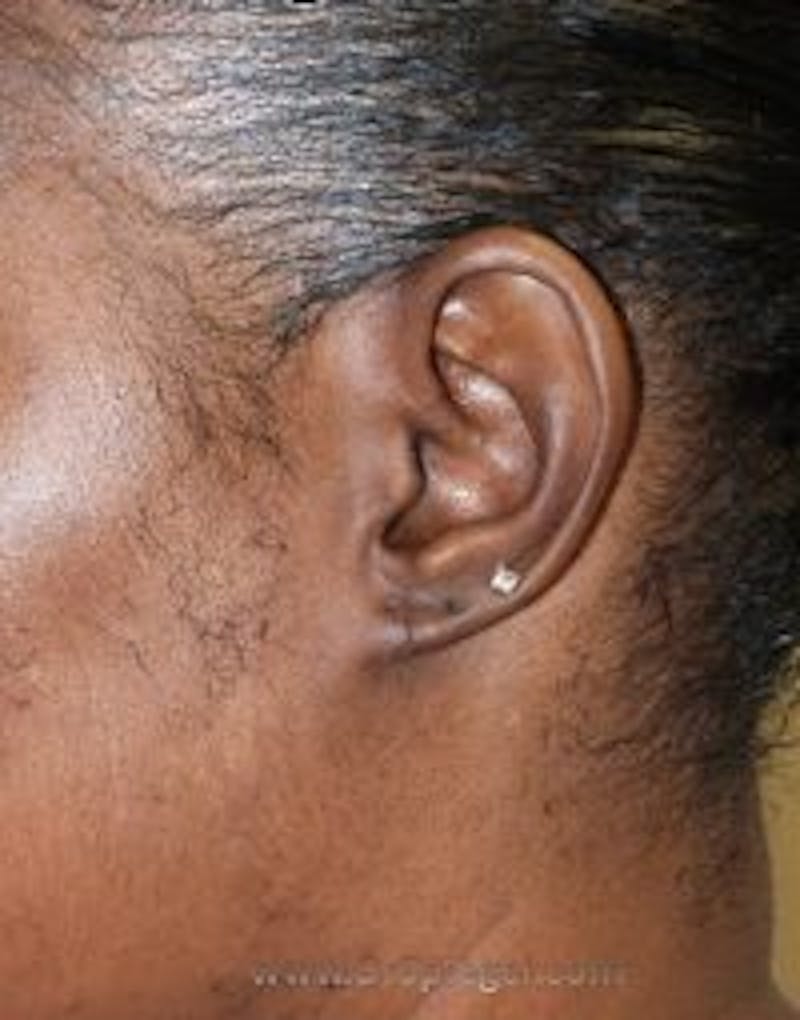 Ear Lobe Repair Before & After Gallery - Patient 157139926 - Image 2