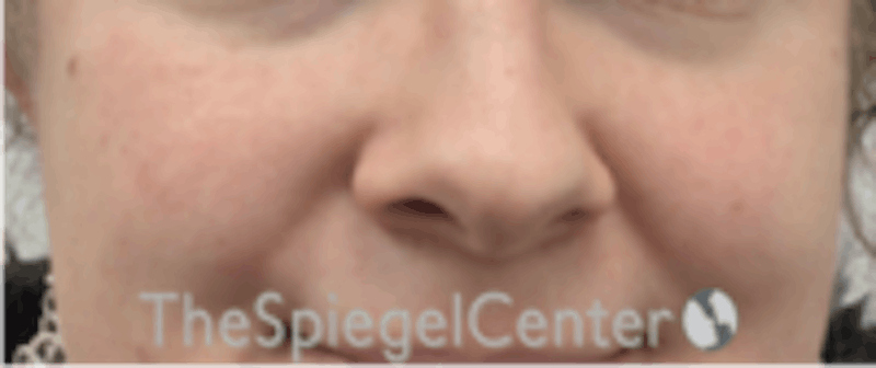 Cheek Implants Before & After Gallery - Patient 157139933 - Image 3