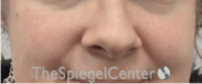 Cheek Implants Before & After Gallery - Patient 157139933 - Image 3