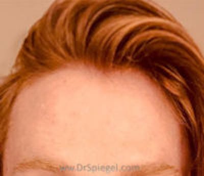 Browlift / Fox Eye Lift Before & After Gallery - Patient 157139929 - Image 1