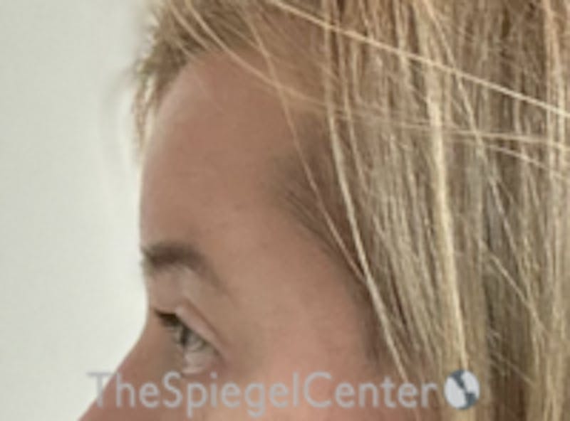 Forehead Contouring Before & After Gallery - Patient 157139927 - Image 4