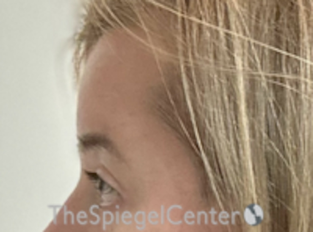 Forehead Contouring