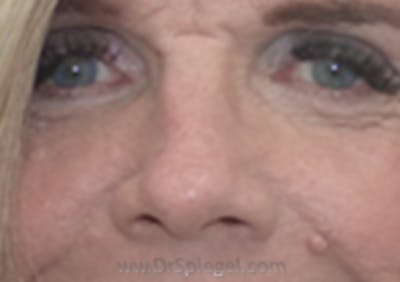 Blepharoplasty Before & After Gallery - Patient 157139930 - Image 1