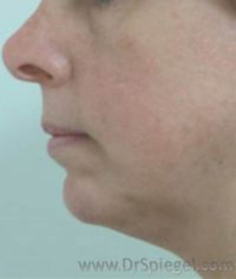 Chin Augmentation in Boston