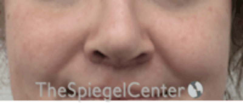 Cheek Implants Before & After Gallery - Patient 157139933 - Image 4