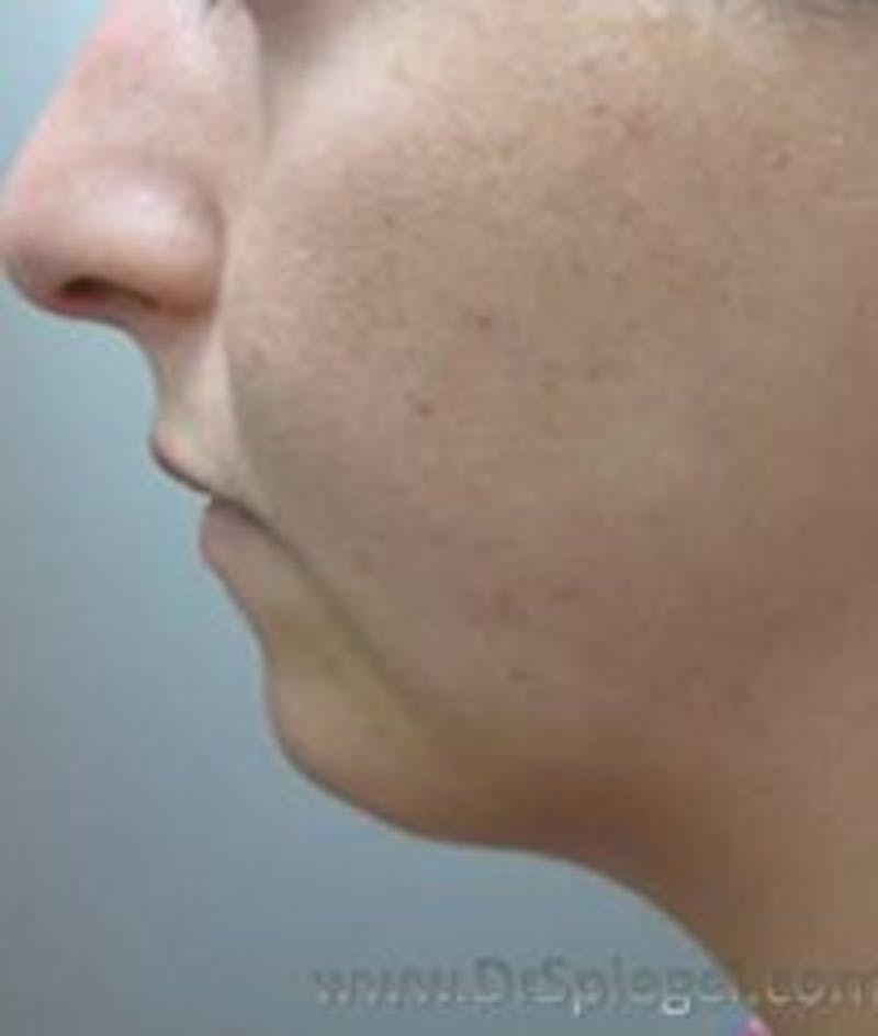 Chin Augmentation Before & After Gallery - Patient 157139932 - Image 1