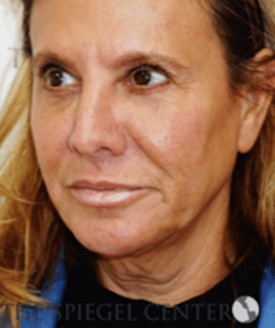 Facelift Before & After Gallery - Patient 157139935 - Image 3