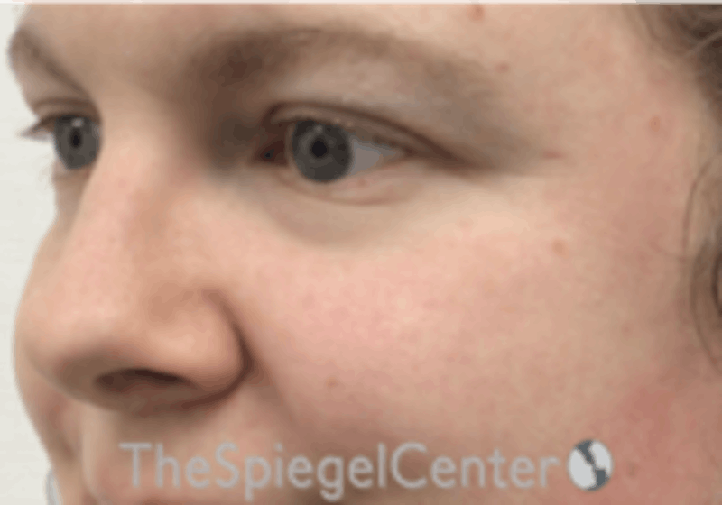Cheek Implants Before & After Gallery - Patient 157139933 - Image 1