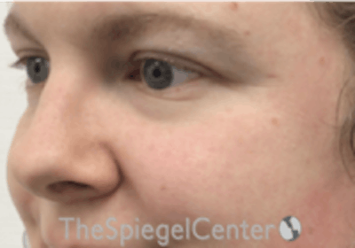 Cheek Implants Before & After Gallery - Patient 157139933 - Image 1