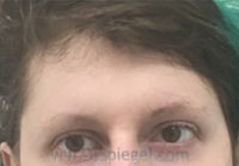 Forehead Contouring Before & After Gallery - Patient 157139936 - Image 1