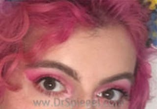 Forehead Contouring Before & After Gallery - Patient 157139936 - Image 2