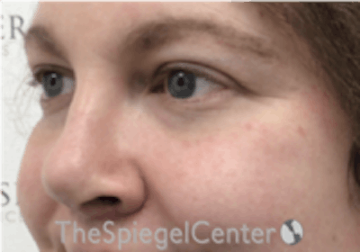 Cheek Implants Before & After Gallery - Patient 157139933 - Image 2
