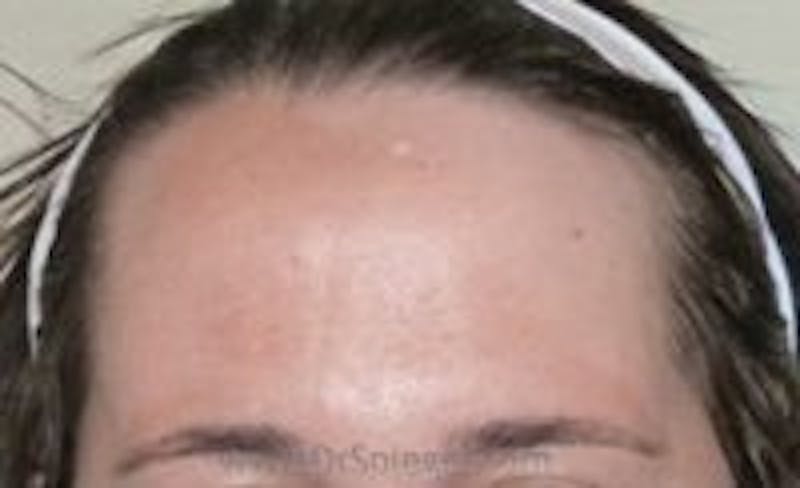 Browlift / Fox Eye Lift Before & After Gallery - Patient 157139934 - Image 1