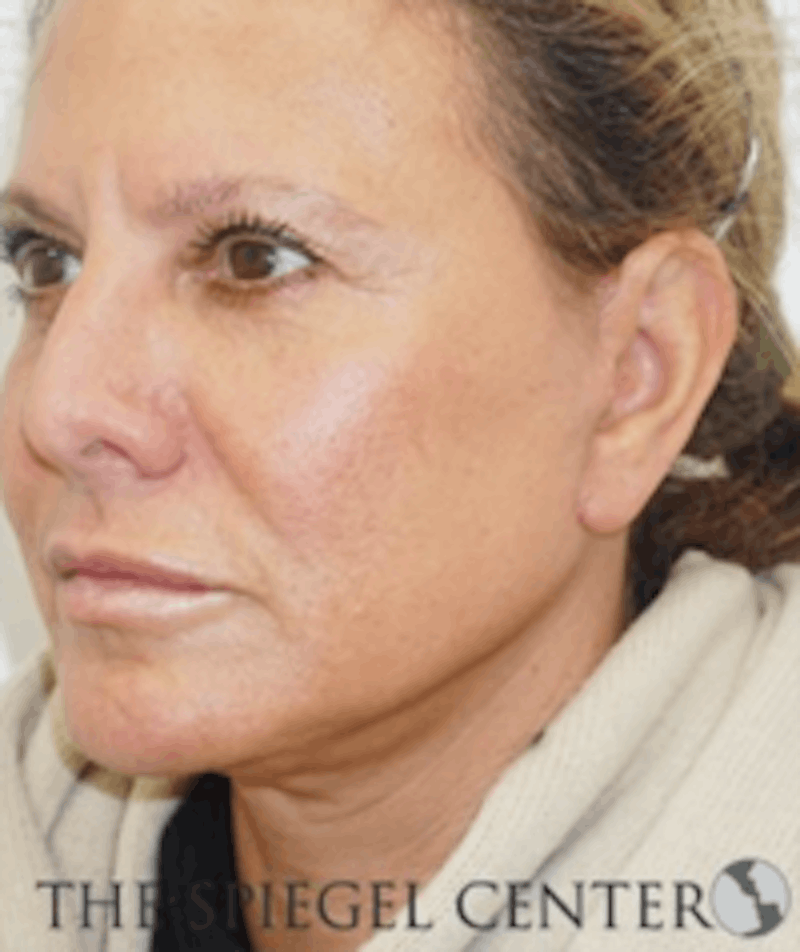 Facelift Before & After Gallery - Patient 157139935 - Image 4