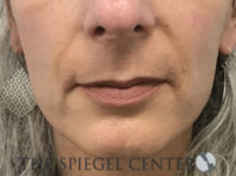 Lip Lift Before & After Gallery - Patient 157139941 - Image 1