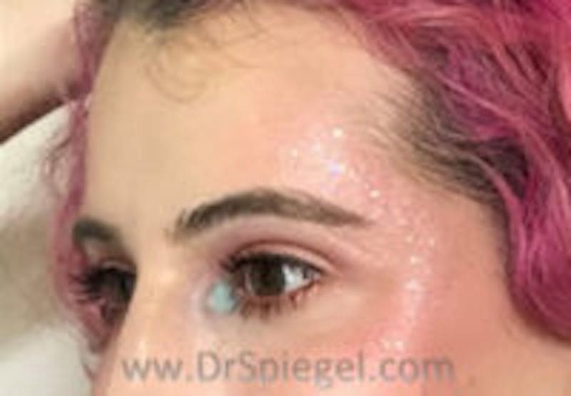 Forehead Contouring Before & After Gallery - Patient 157139936 - Image 4