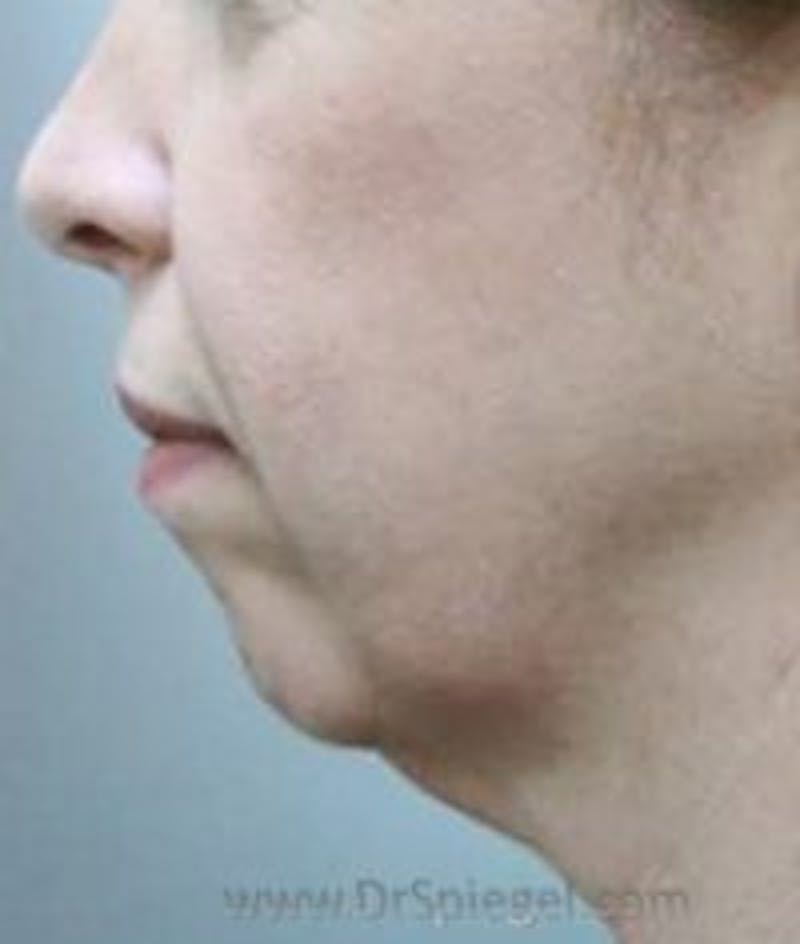 Chin Augmentation Before & After Gallery - Patient 157139939 - Image 1