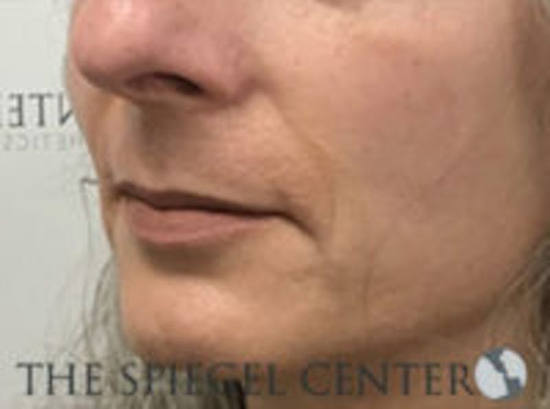 Lip Augmentation / Lip Implant / Lip Lift Before & After Gallery - Patient 157139941 - Image 3