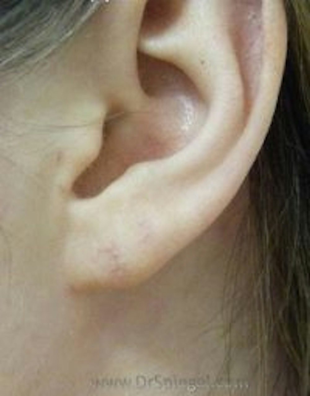 Earlobe Repair