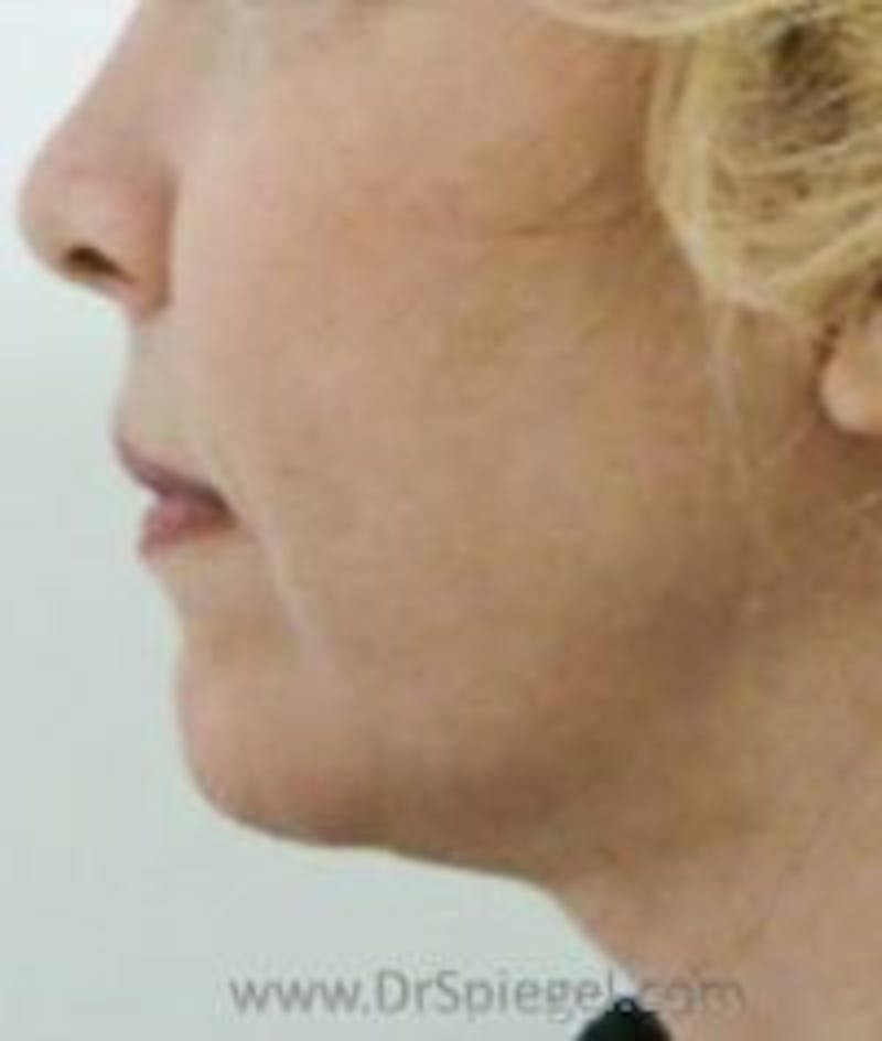 Chin Augmentation Before & After Gallery - Patient 157139939 - Image 2