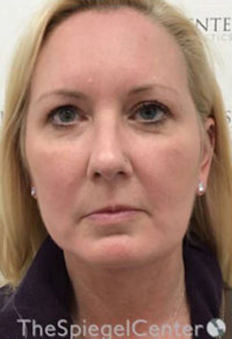 Facelift Before & After Gallery - Patient 157139947 - Image 2