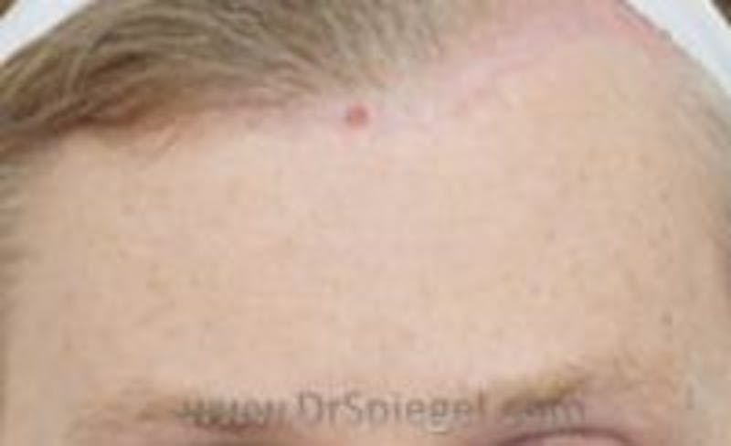 Browlift / Fox Eye Lift Before & After Gallery - Patient 157139940 - Image 2