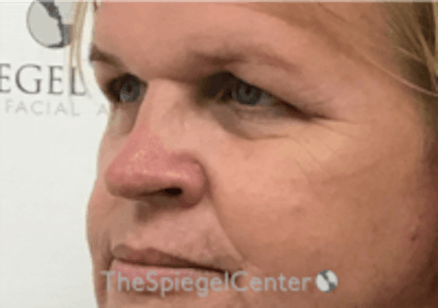 Cheek Implants Before & After Gallery - Patient 157139946 - Image 1