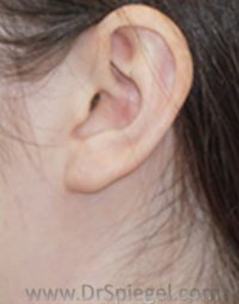 Ear Lobe Repair Before & After Gallery - Patient 157139944 - Image 2