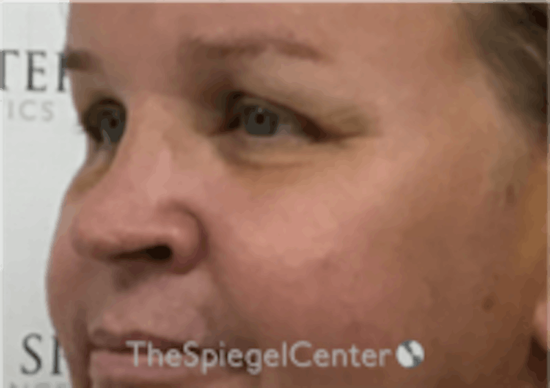 Cheek Implants Before & After Gallery - Patient 157139946 - Image 2