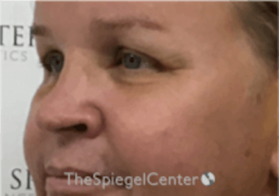Cheek Implants Before & After Gallery - Patient 157139946 - Image 2