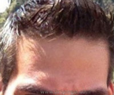 Browlift / Fox Eye Lift Before & After Gallery - Patient 157139948 - Image 1