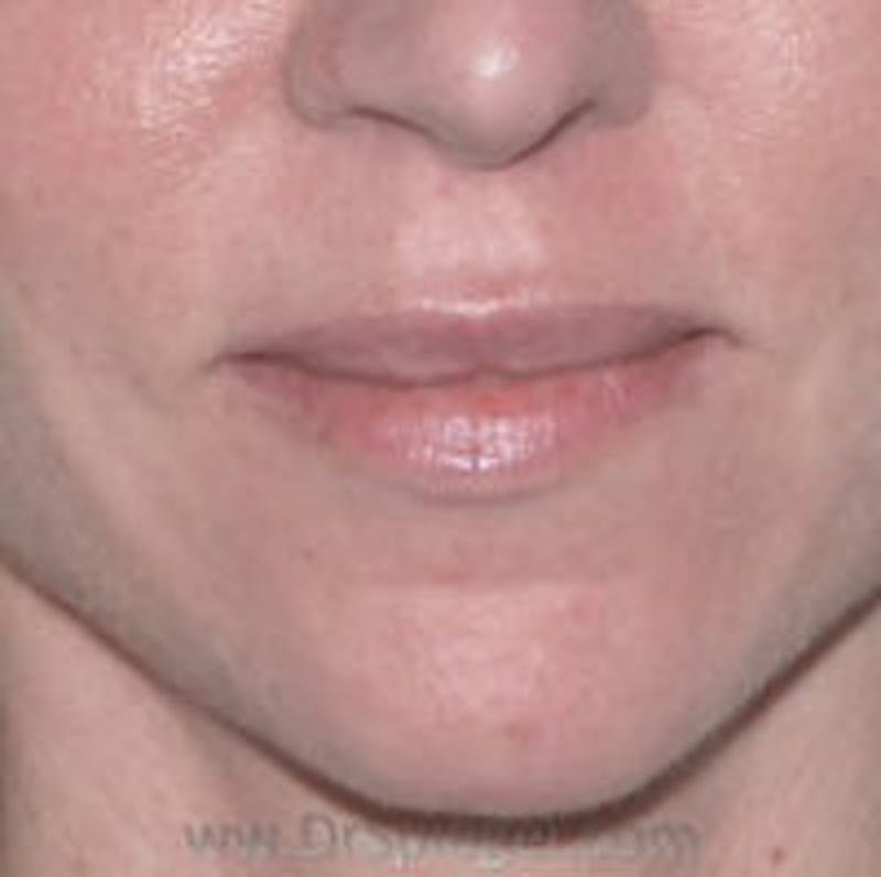 Lip Augmentation / Lip Implant / Lip Lift Before & After Gallery - Patient 157139951 - Image 1