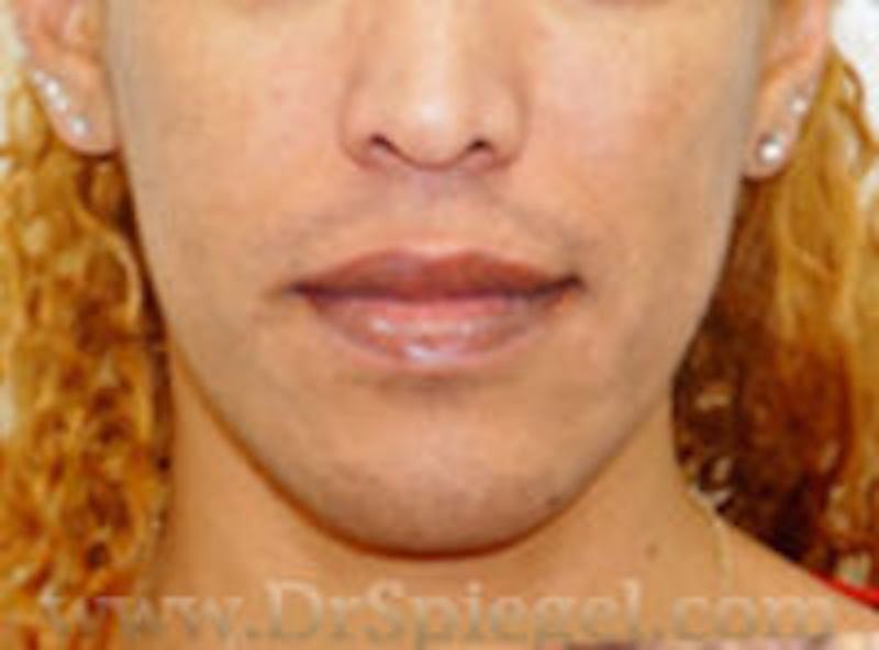 Mandible Contouring Before & After Gallery - Patient 157139953 - Image 1