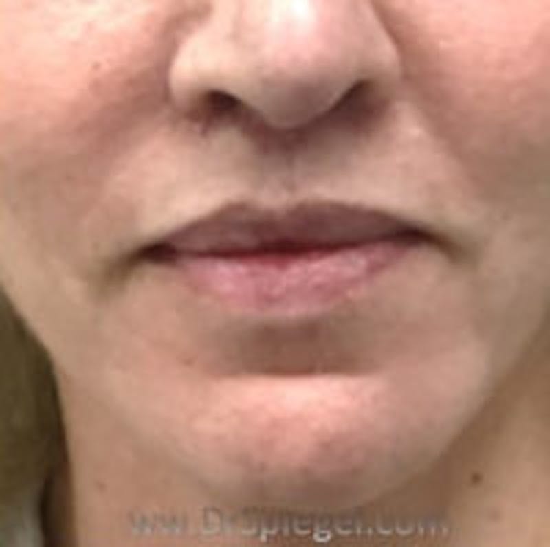Lip Augmentation / Lip Implant / Lip Lift Before & After Gallery - Patient 157139951 - Image 2
