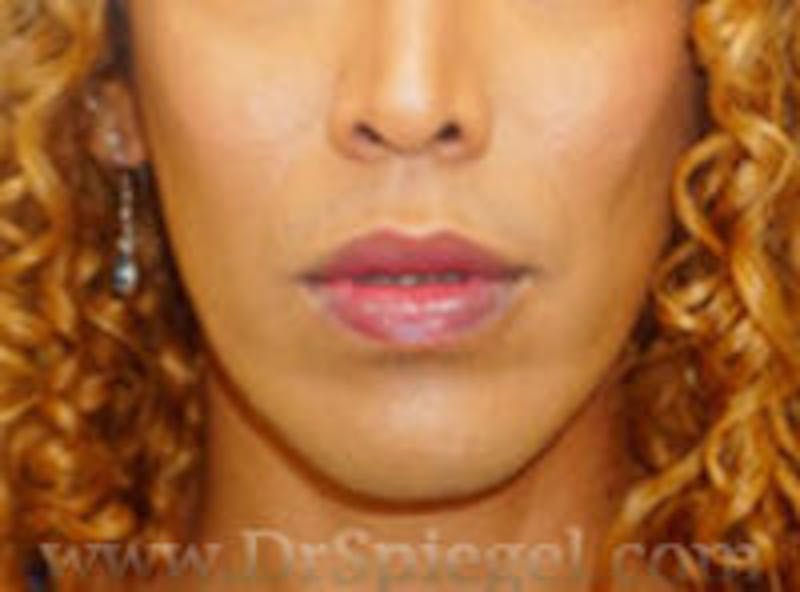 Mandible Contouring Before & After Gallery - Patient 157139953 - Image 2