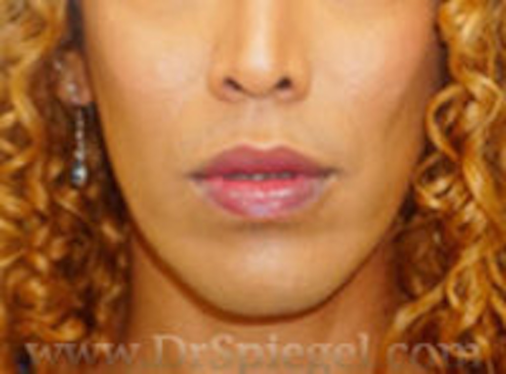Mandible Contouring