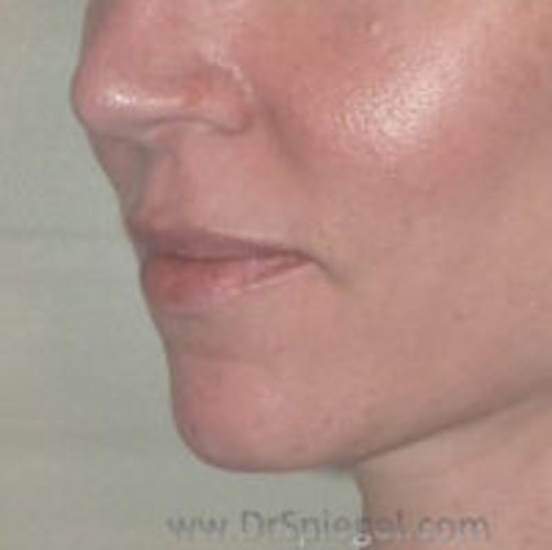 Lip Augmentation / Lip Implant / Lip Lift Before & After Gallery - Patient 157139951 - Image 3