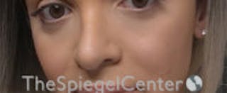 Cheek Implants Before & After Gallery - Patient 157139955 - Image 4