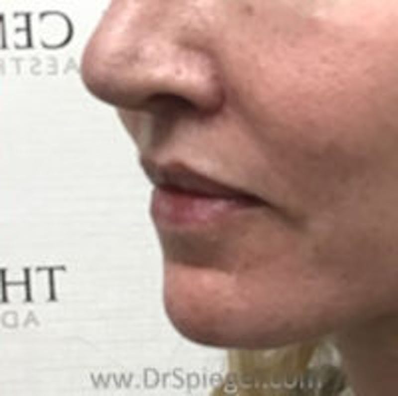 Lip Augmentation / Lip Implant / Lip Lift Before & After Gallery - Patient 157139951 - Image 4