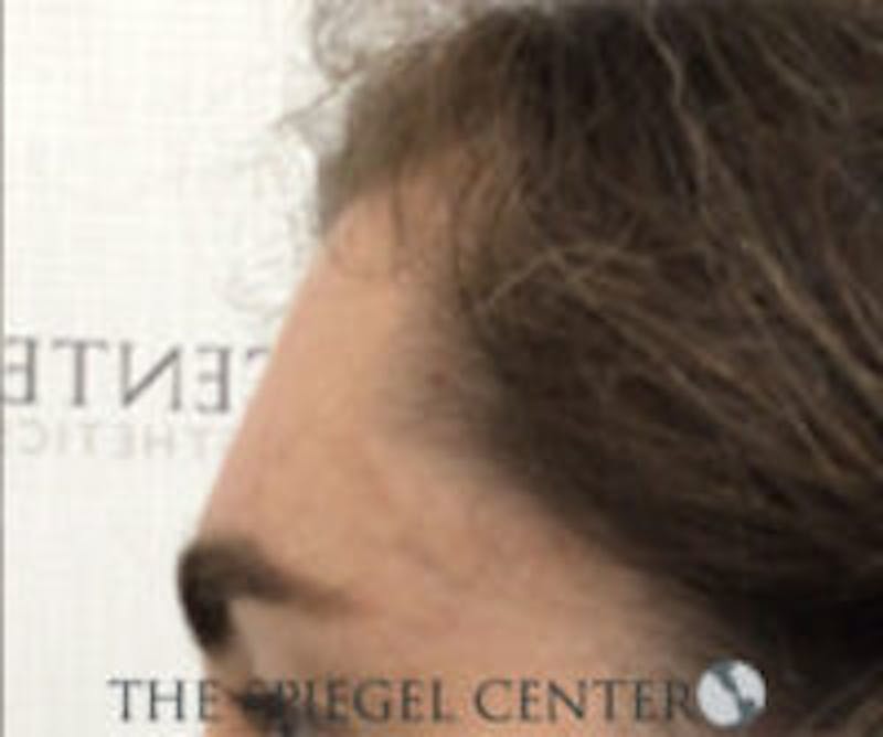 Forehead Contouring Before & After Gallery - Patient 157139950 - Image 4