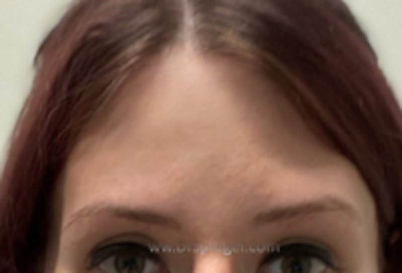 Browlift / Fox Eye Lift Before & After Gallery - Patient 157139952 - Image 2