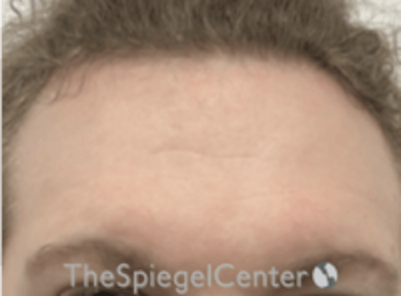 Forehead Contouring Before & After Gallery - Patient 157139962 - Image 1