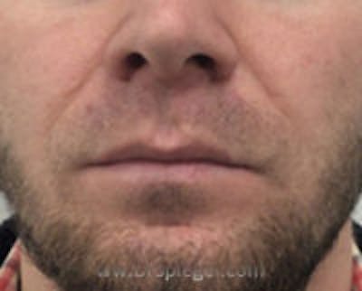 Lip Lift Before & After Gallery - Patient 157139959 - Image 1