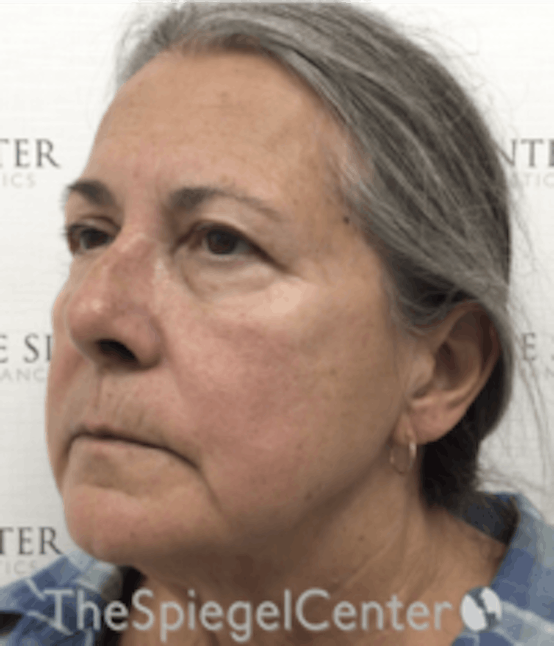 Facelift Before & After Gallery - Patient 157139956 - Image 3