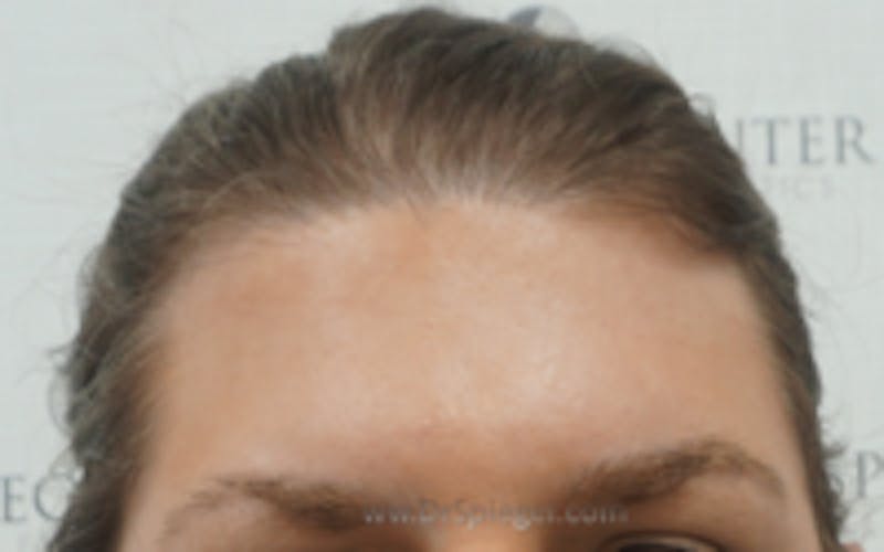 Browlift / Fox Eye Lift Before & After Gallery - Patient 157139957 - Image 1