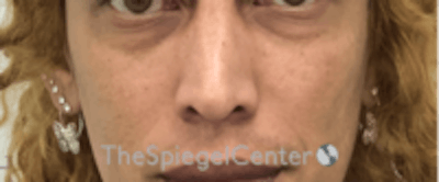 Cheek Implants Before & After Gallery - Patient 157139965 - Image 3