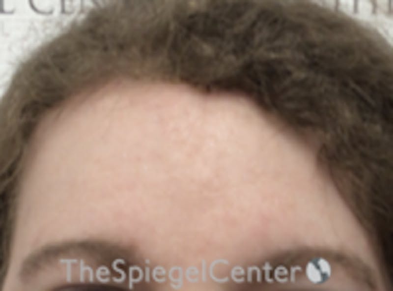 Forehead Contouring Before & After Gallery - Patient 157139962 - Image 2