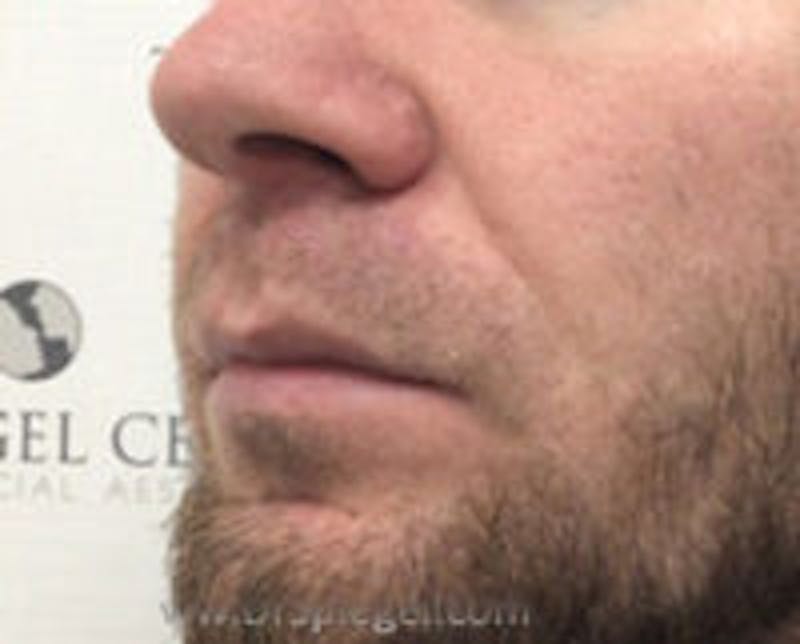 Lip Augmentation / Lip Implant / Lip Lift Before & After Gallery - Patient 157139959 - Image 3