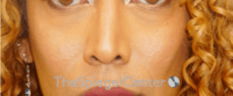 Cheek Implants Before & After Gallery - Patient 157139965 - Image 4
